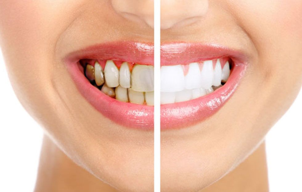 Does Getting Your Teeth Cleaned Hurt?