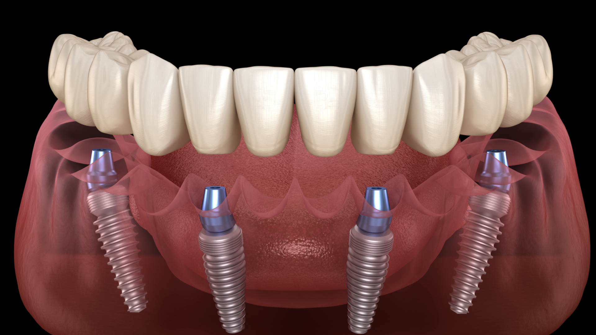 https://65broadwaydental.com/wp-content/uploads/2025/05/06-guide-all-on-4.jpg