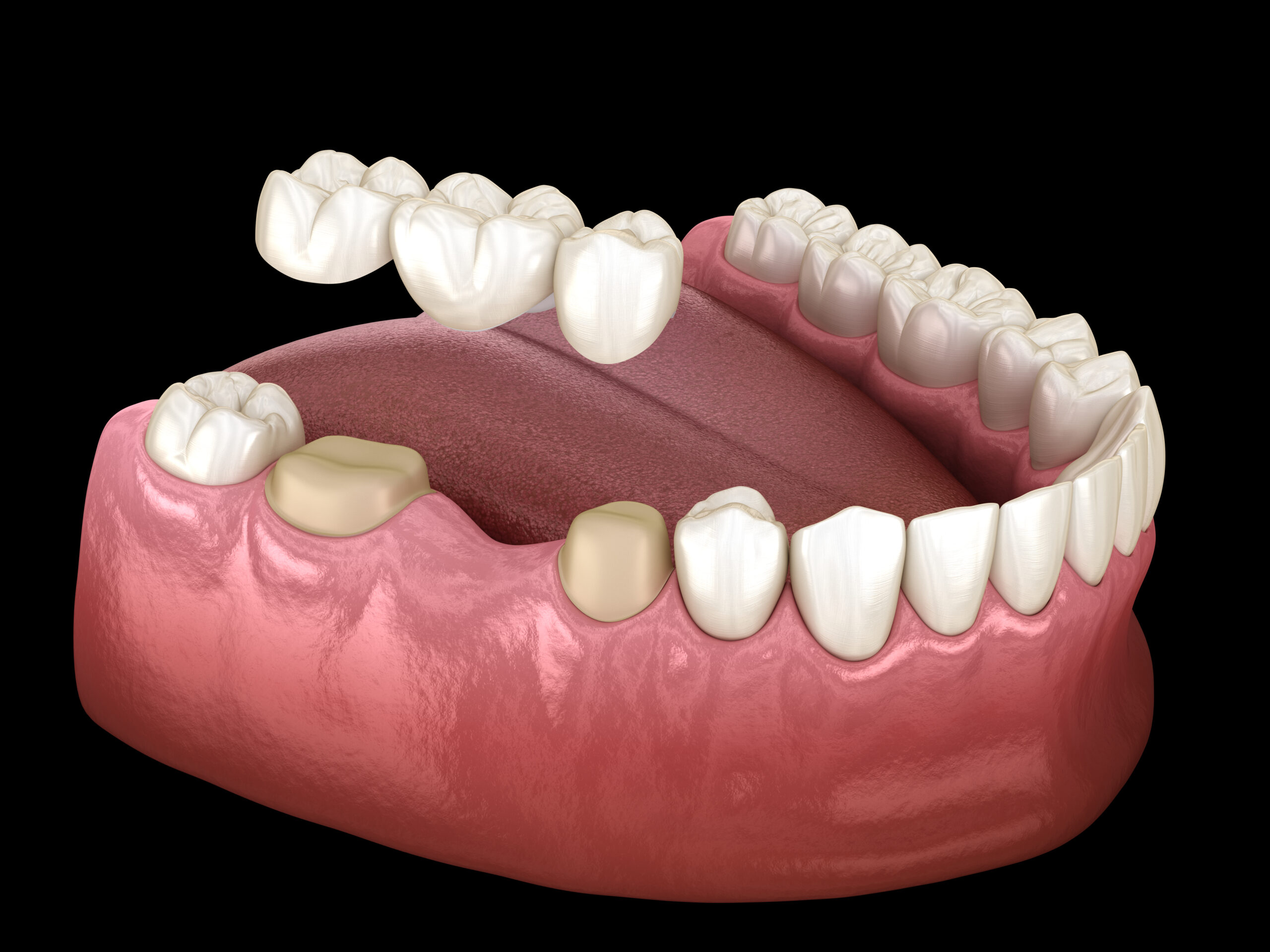 https://65broadwaydental.com/wp-content/uploads/2025/05/Dental-Bridges-scaled-1.jpg