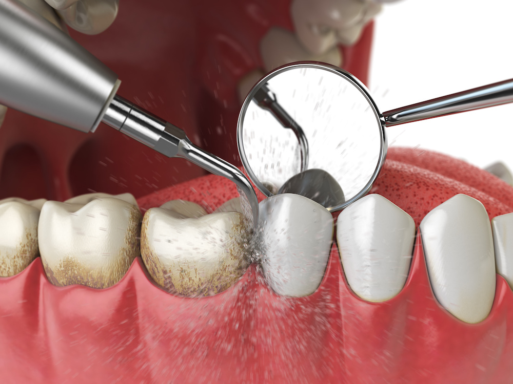 https://65broadwaydental.com/wp-content/uploads/2025/05/When-Do-You-Need-a-Deep-Teeth-Cleaning-vs.-a-Regular-Cleaning.jpeg