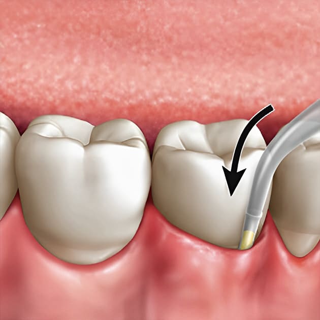 https://65broadwaydental.com/wp-content/uploads/2025/05/arestin.jpg