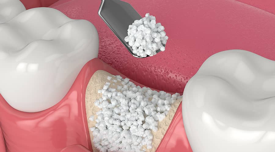 https://65broadwaydental.com/wp-content/uploads/2025/05/bone-grafting.jpg
