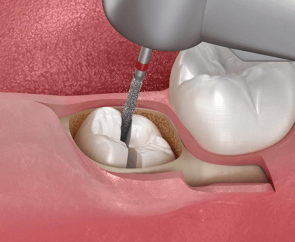https://65broadwaydental.com/wp-content/uploads/2025/05/coronectomy-surgery.png