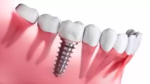 https://65broadwaydental.com/wp-content/uploads/2025/05/dental-implant.webp