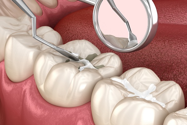https://65broadwaydental.com/wp-content/uploads/2025/05/dental-sealants-2109.jpg