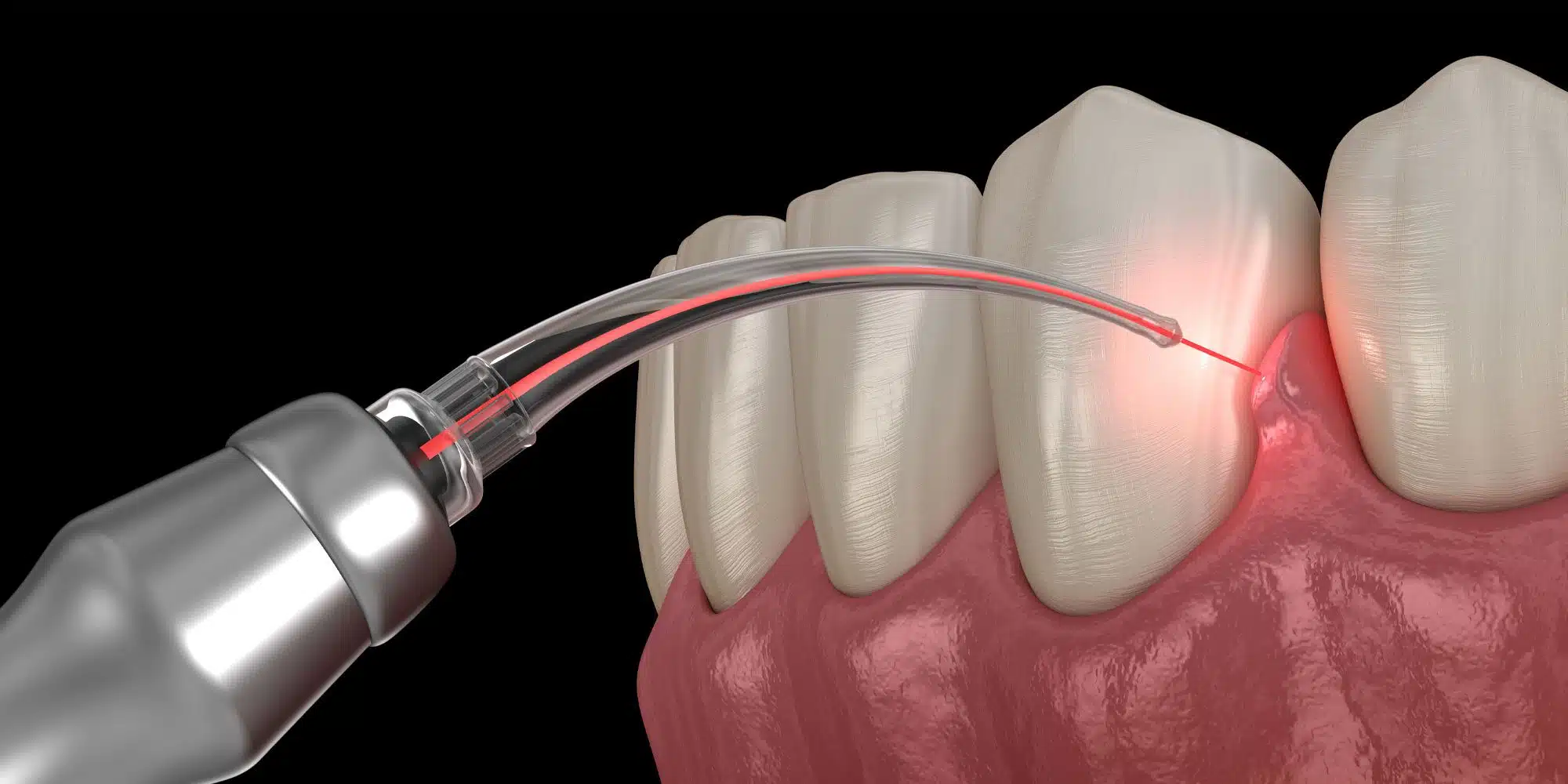 https://65broadwaydental.com/wp-content/uploads/2025/05/lanap-treatment.jpg.webp