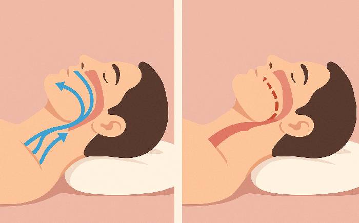 Sleep apnea