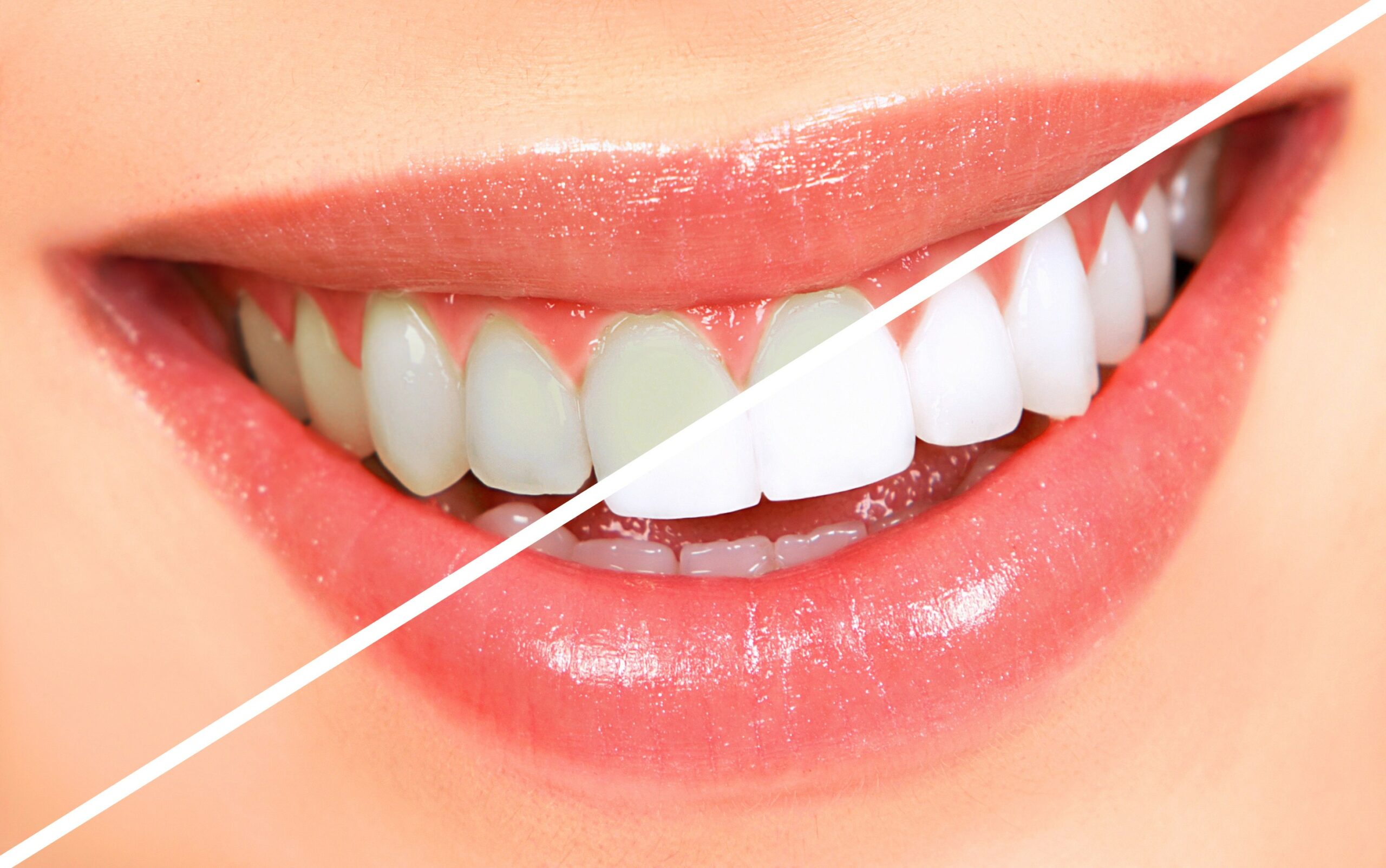 https://65broadwaydental.com/wp-content/uploads/2025/05/teeth-whitening.jpg