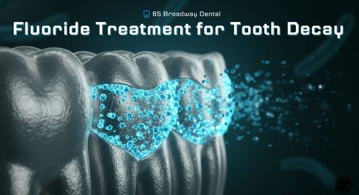 Why Fluoride Treatment for Tooth Decay Matters to You