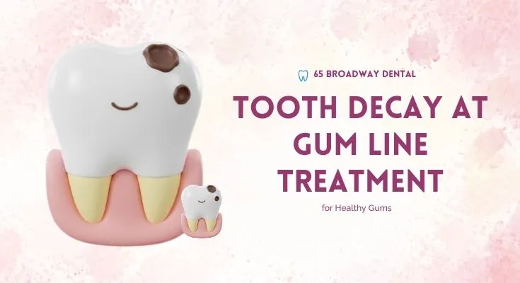Tooth Decay at Gum Line Treatment: Your No-Nonsense Guide to Fixing